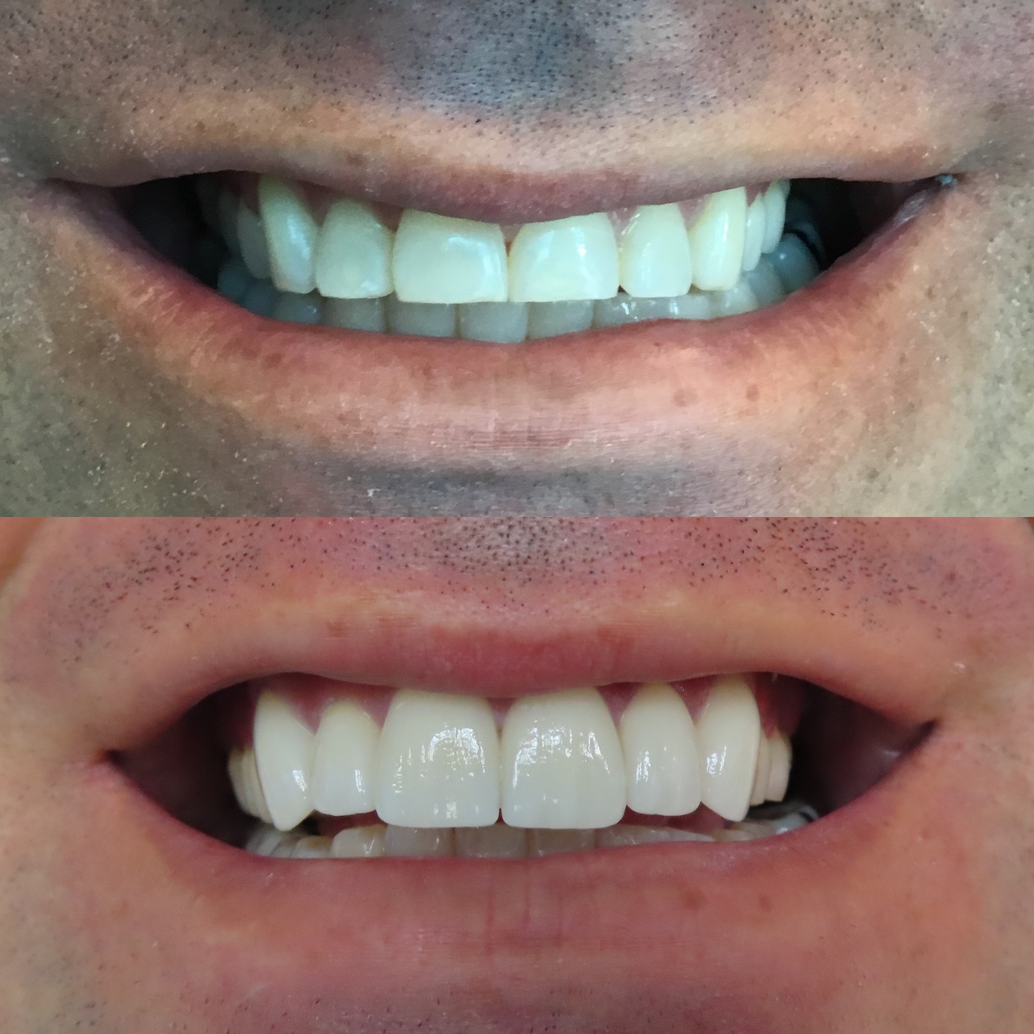 Veneers & Lumineers in Denver OG Dental 80211